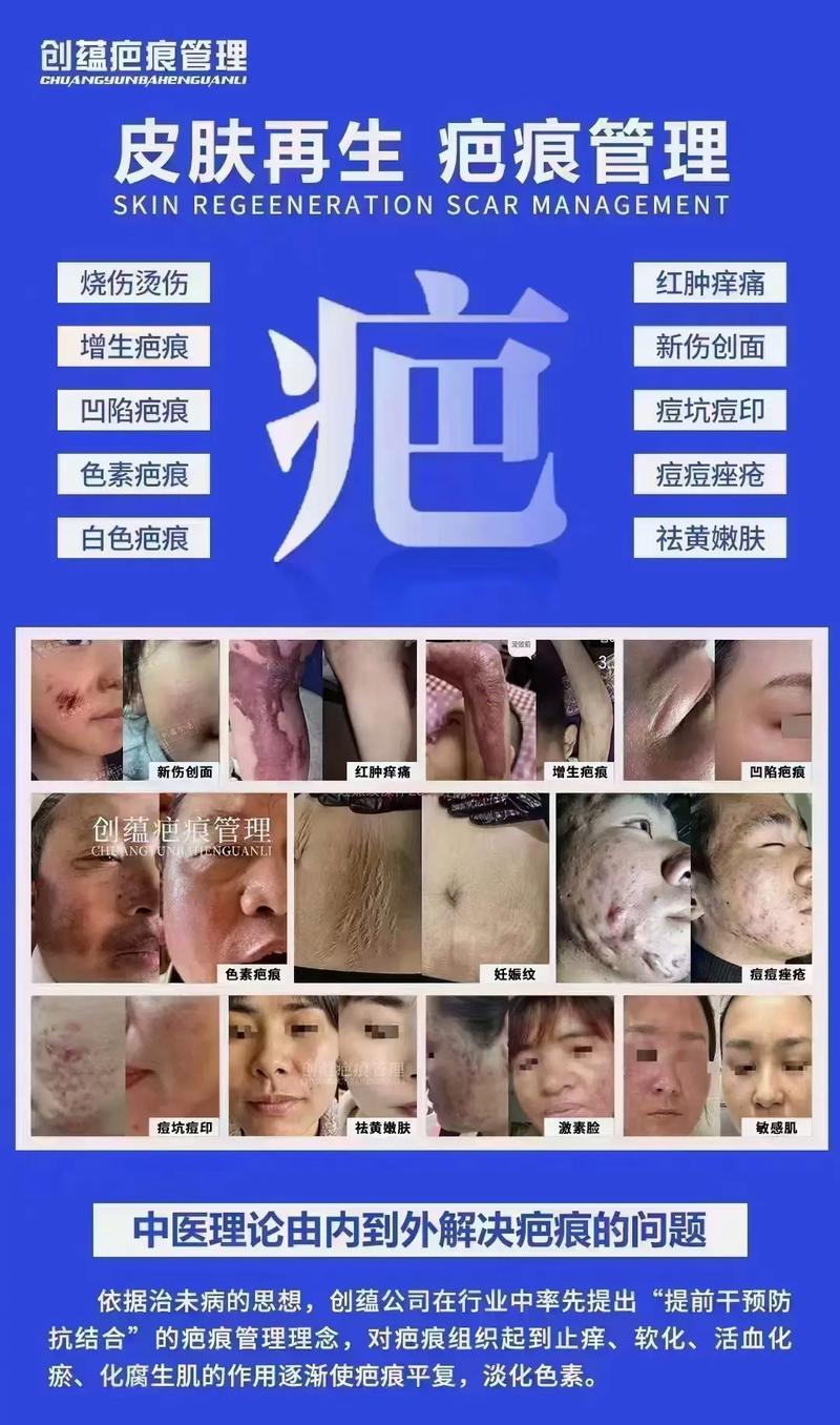 斑疤敏痘紋痘坑全解析 創蘊除疤精準修護，重塑無瑕美肌